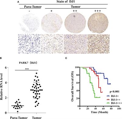 DJ-1 promotes osteosarcoma progression through activating CDK4/RB/E2F1 signaling pathway